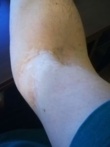 Vlad's arm scar